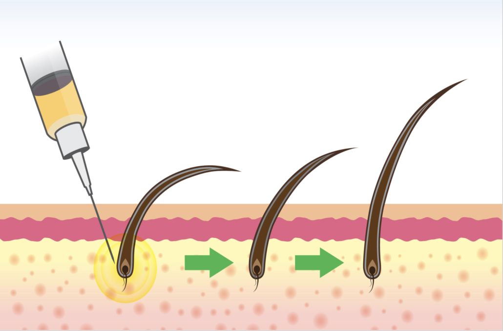 Stem Cell Therapy for Hair Loss Developments