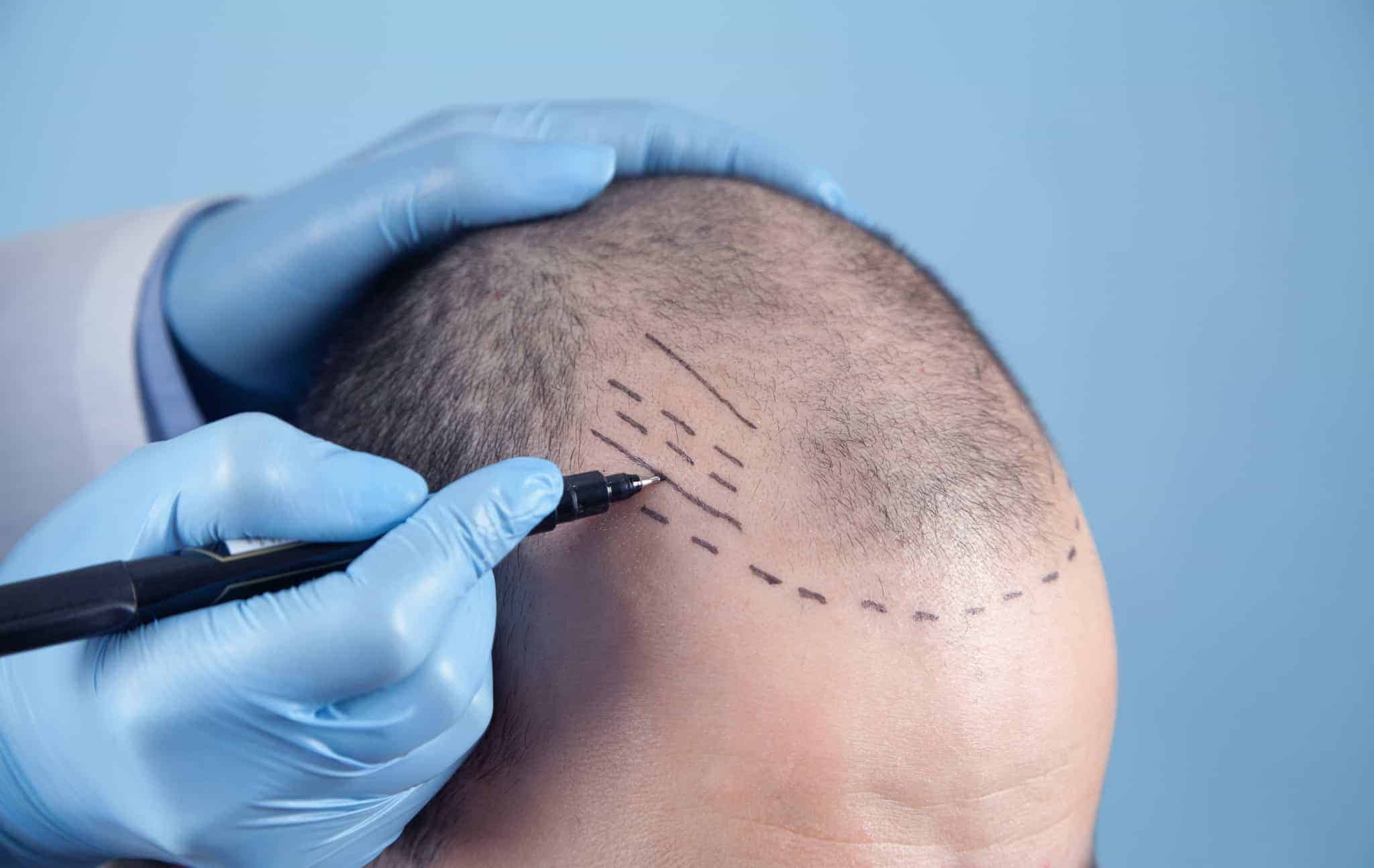 How Long Does A Hair Transplant Last? What You Need To Know