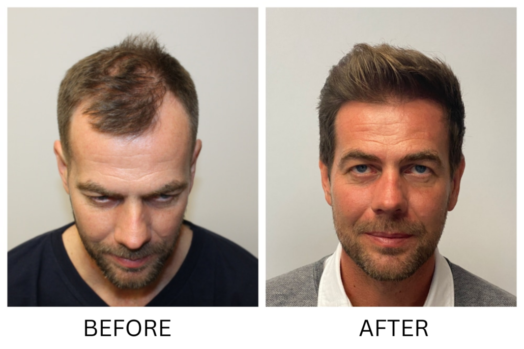 before and after hair transplant photo Scottsdale AZ