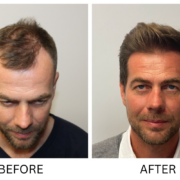 before and after hair transplant photo Scottsdale AZ