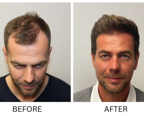 before and after hair transplant photo Scottsdale AZ
