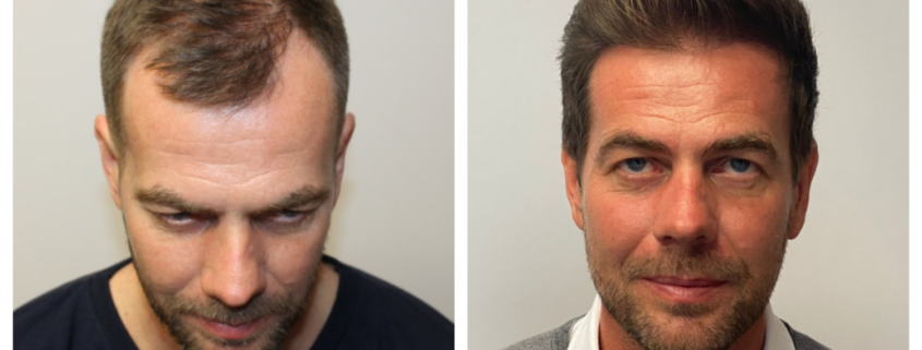 before and after hair transplant photo Scottsdale AZ